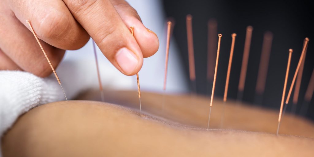 Benefits of Acupuncture 1