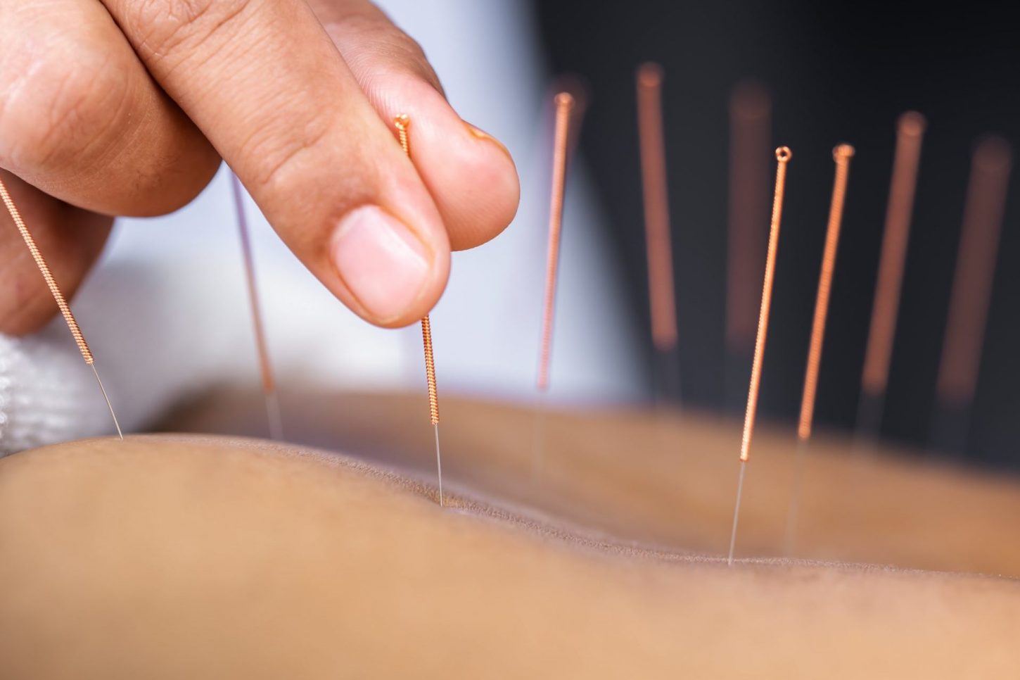 acupuncture